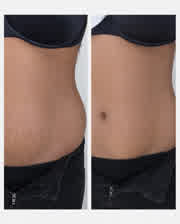 ReFirm before and after — Melissa
