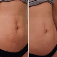 ReFirm before and after — Michelle