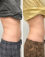 ReFirm before and after — Sarah